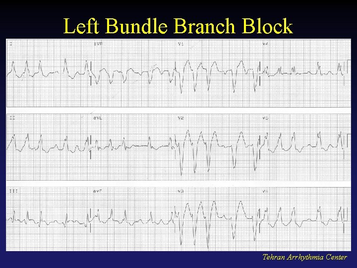 Left Bundle Branch Block Tehran Arrhythmia Center 