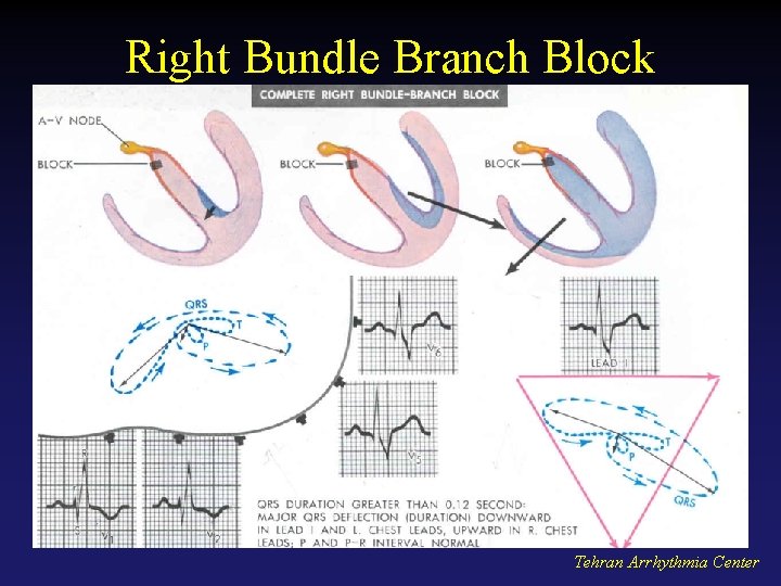 Right Bundle Branch Block Tehran Arrhythmia Center 