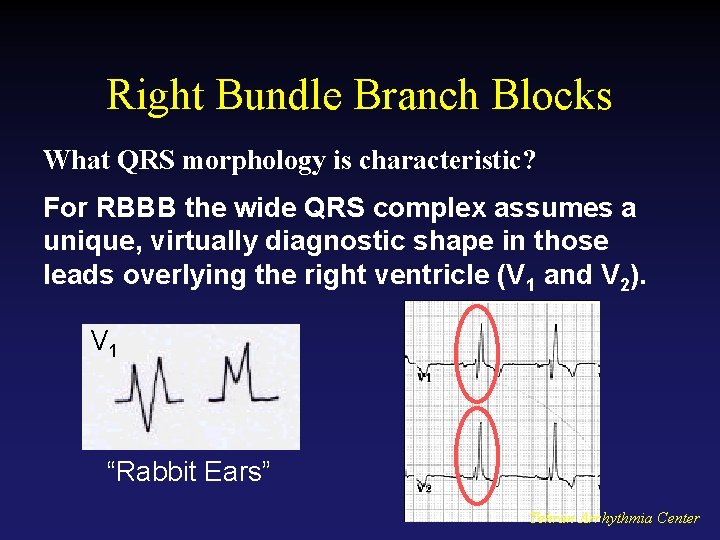 Right Bundle Branch Blocks What QRS morphology is characteristic? For RBBB the wide QRS