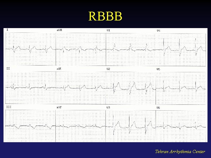 RBBB Tehran Arrhythmia Center 