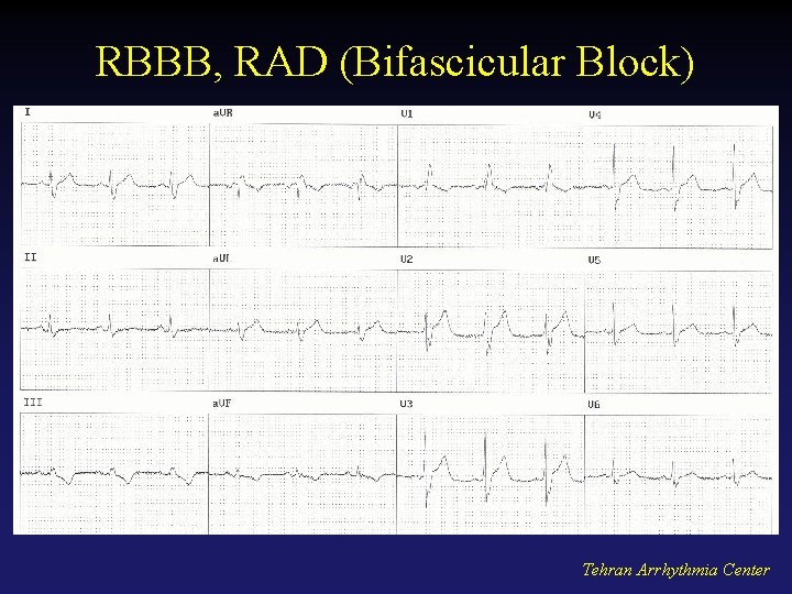 RBBB, RAD (Bifascicular Block) Tehran Arrhythmia Center 