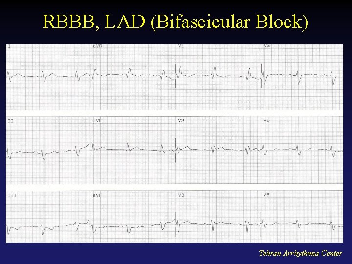 RBBB, LAD (Bifascicular Block) Tehran Arrhythmia Center 