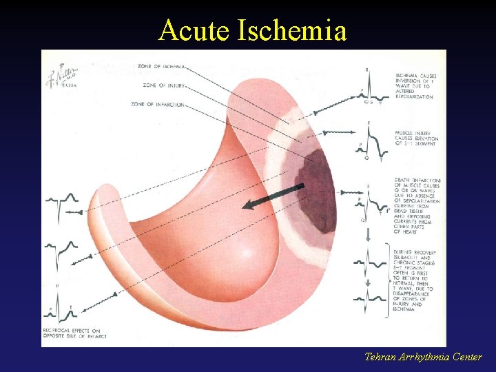 Acute Ischemia Tehran Arrhythmia Center 
