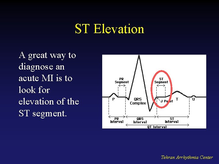 ST Elevation A great way to diagnose an acute MI is to look for