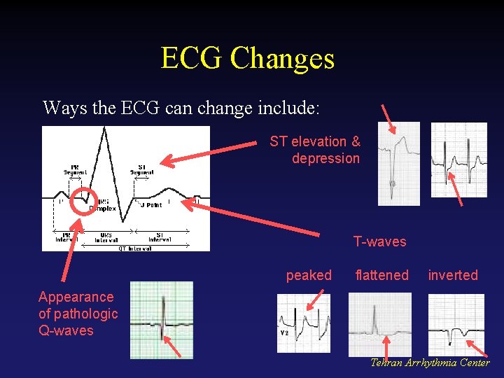 ECG Changes Ways the ECG can change include: ST elevation & depression T-waves peaked