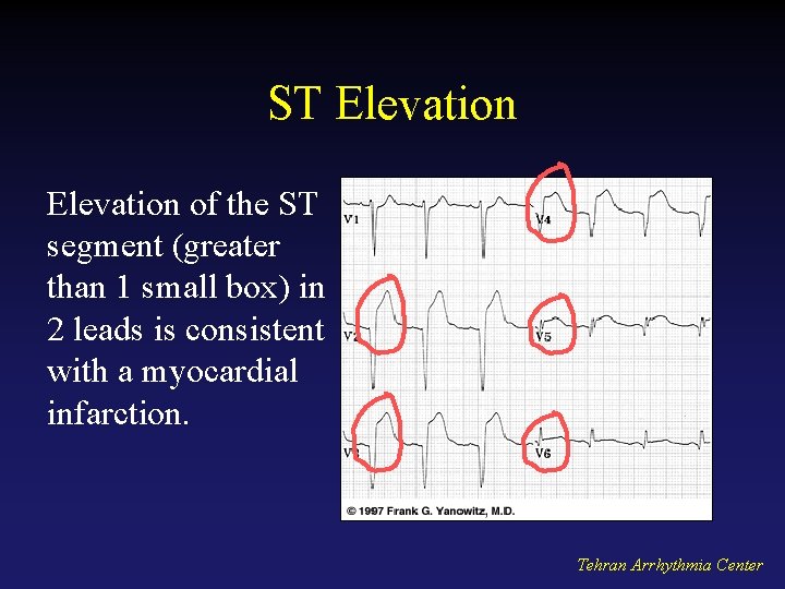 ST Elevation of the ST segment (greater than 1 small box) in 2 leads