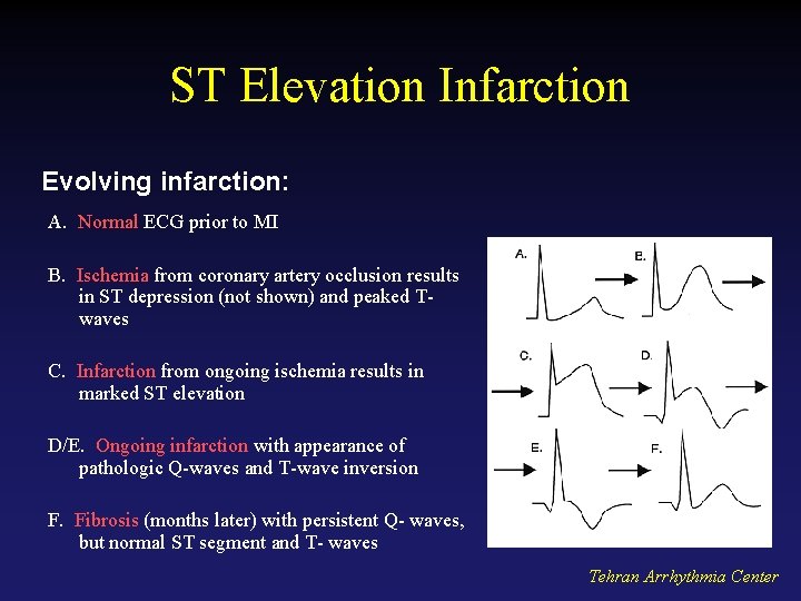 ST Elevation Infarction Evolving infarction: A. Normal ECG prior to MI B. Ischemia from