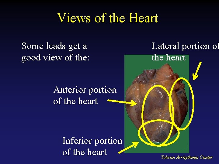 Views of the Heart Some leads get a good view of the: Lateral portion
