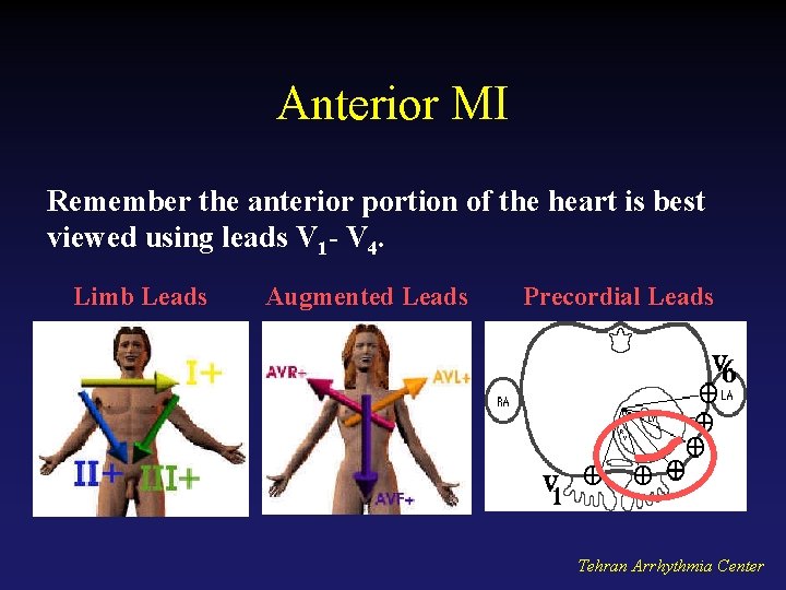 Anterior MI Remember the anterior portion of the heart is best viewed using leads