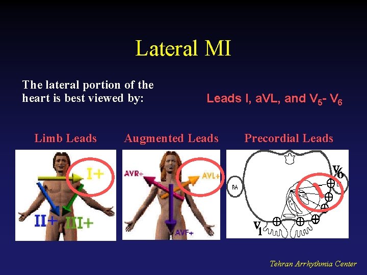 Lateral MI The lateral portion of the heart is best viewed by: Limb Leads