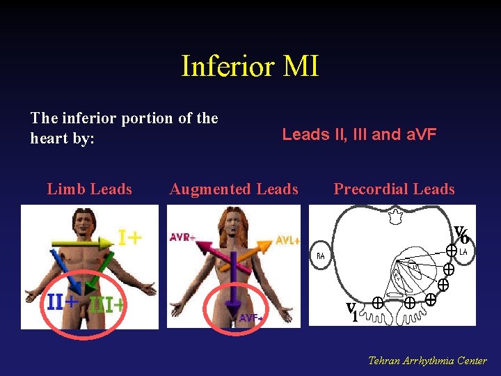 Inferior MI The inferior portion of the heart by: Limb Leads II, III and