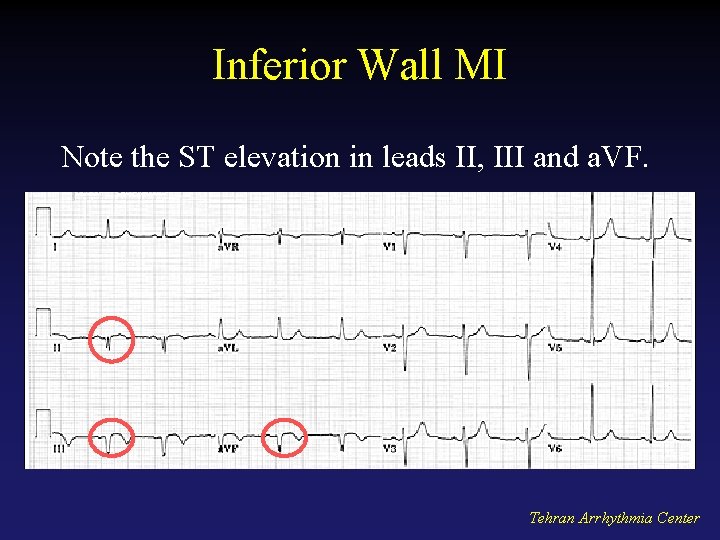 Inferior Wall MI Note the ST elevation in leads II, III and a. VF.