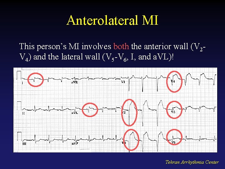 Anterolateral MI This person’s MI involves both the anterior wall (V 2 V 4)