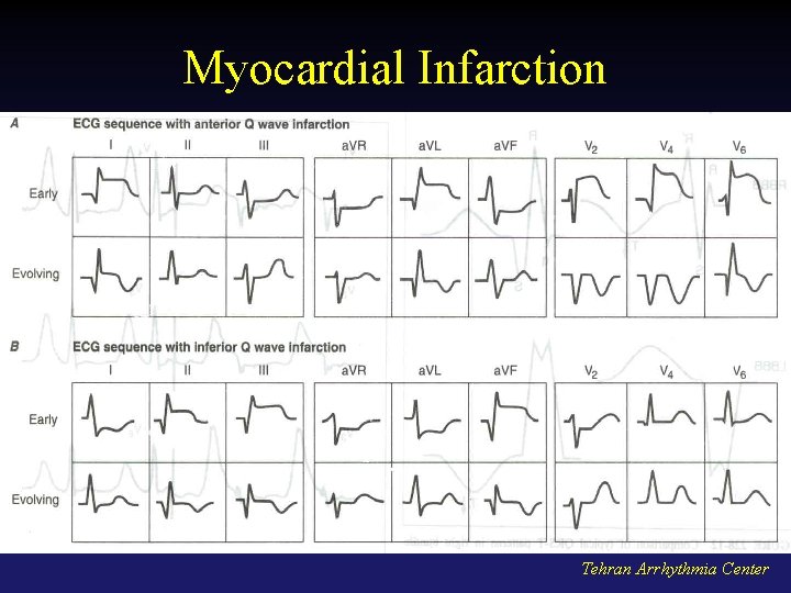 Myocardial Infarction Tehran Arrhythmia Center 