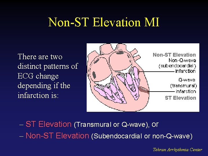 Non-ST Elevation MI There are two distinct patterns of ECG change depending if the