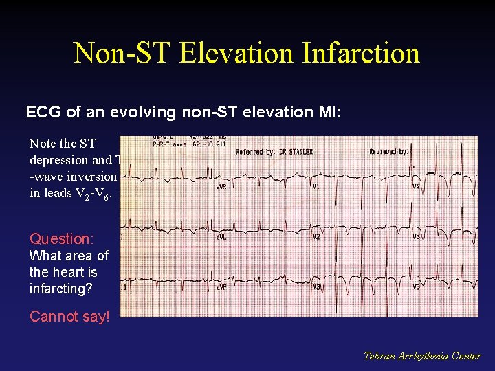 Non-ST Elevation Infarction ECG of an evolving non-ST elevation MI: Note the ST depression