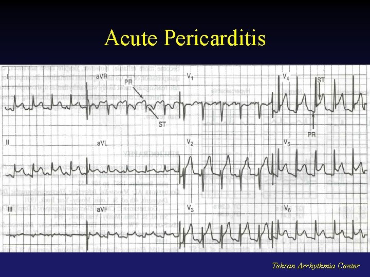 Acute Pericarditis Tehran Arrhythmia Center 