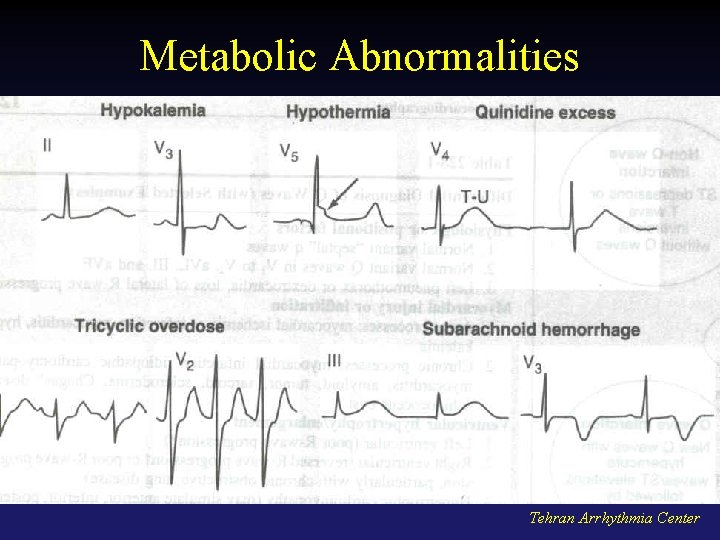 Metabolic Abnormalities Tehran Arrhythmia Center 