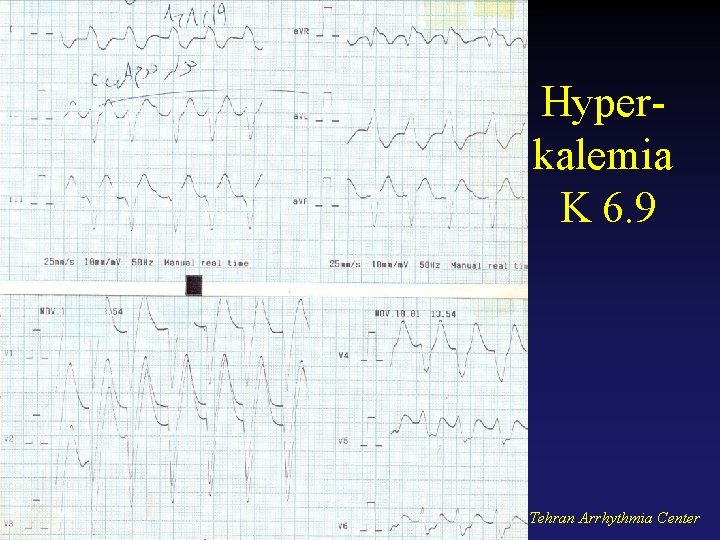 Hyperkalemia K 6. 9 Tehran Arrhythmia Center 