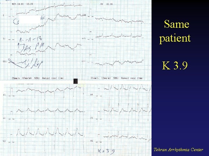 Same patient K 3. 9 Tehran Arrhythmia Center 