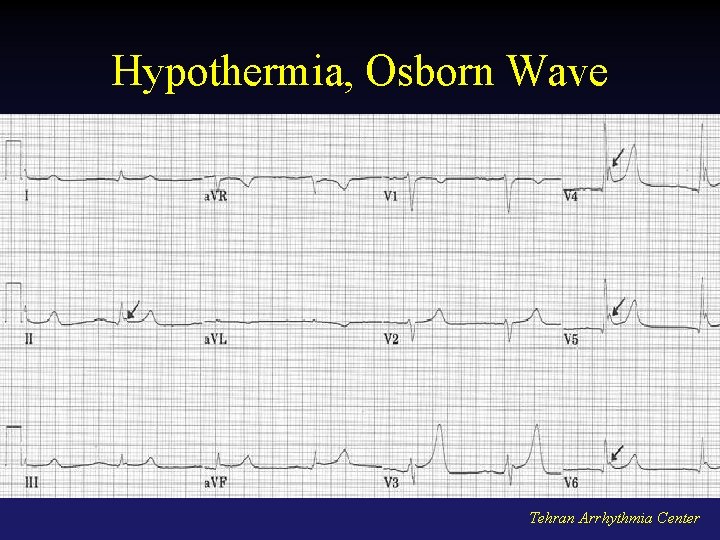 Hypothermia, Osborn Wave Tehran Arrhythmia Center 