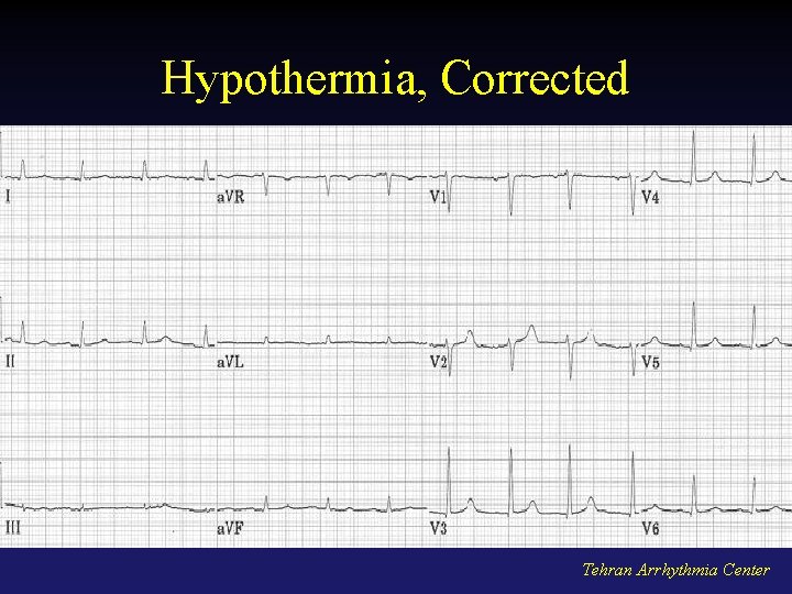 Hypothermia, Corrected Tehran Arrhythmia Center 