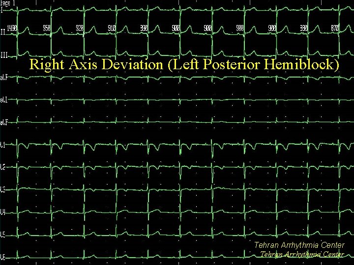 Right Axis Deviation (Left Posterior Hemiblock) Tehran Arrhythmia Center 