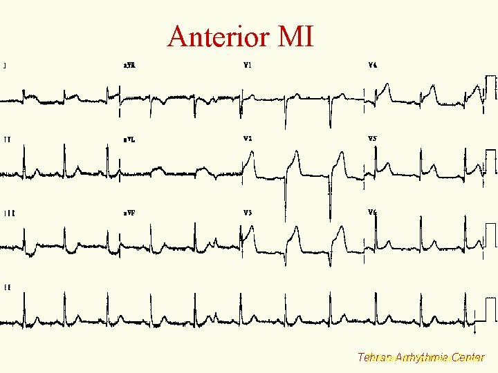 Anterior MI Tehran. Arrhythmia. Center Tehran 