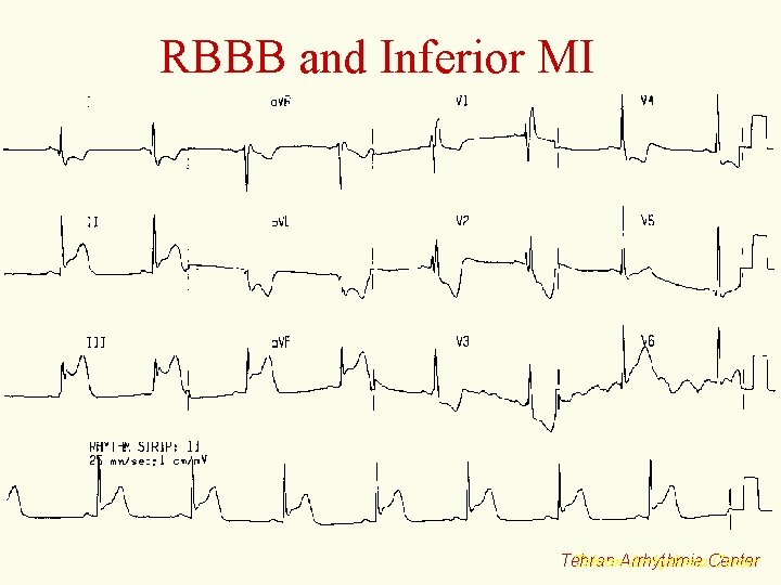 RBBB and Inferior MI Tehran. Arrhythmia. Center Tehran 