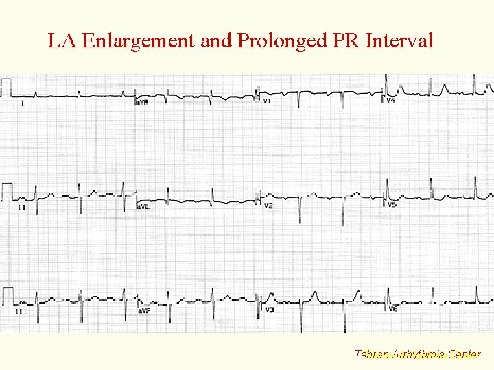 LA Enlargement and Prolonged PR Interval Tehran. Arrhythmia. Center Tehran 