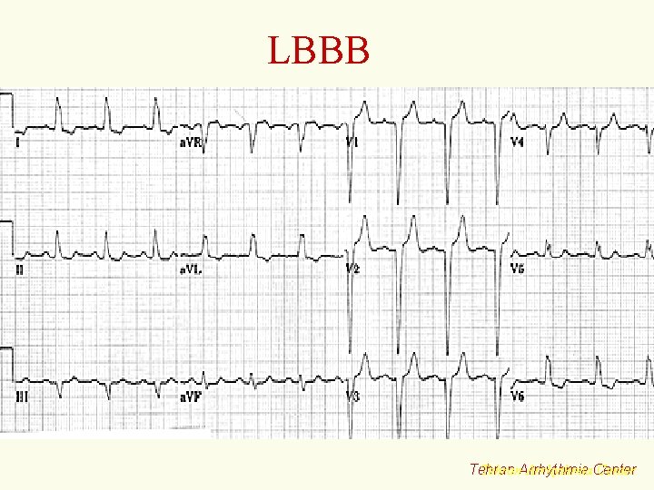 LBBB Tehran. Arrhythmia. Center Tehran 