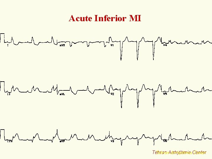 Acute Inferior MI Tehran. Arrhythmia. Center Tehran 
