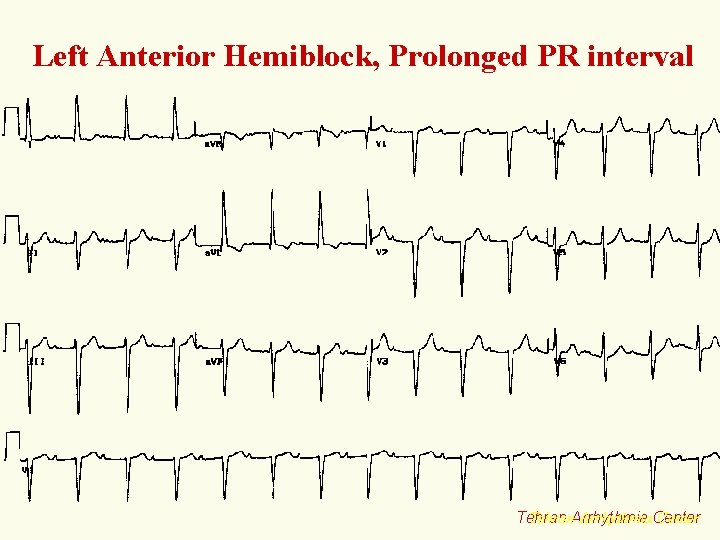 Left Anterior Hemiblock, Prolonged PR interval Tehran. Arrhythmia. Center Tehran 