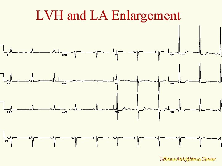 LVH and LA Enlargement Tehran. Arrhythmia. Center Tehran 