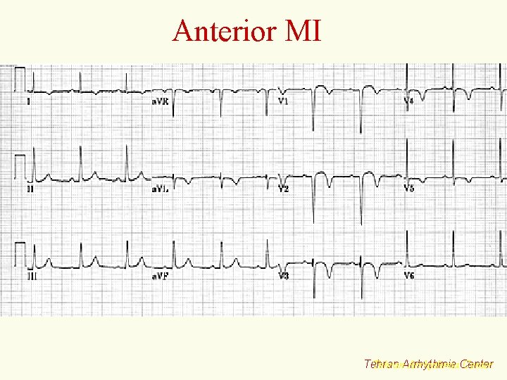 Anterior MI Tehran. Arrhythmia. Center Tehran 