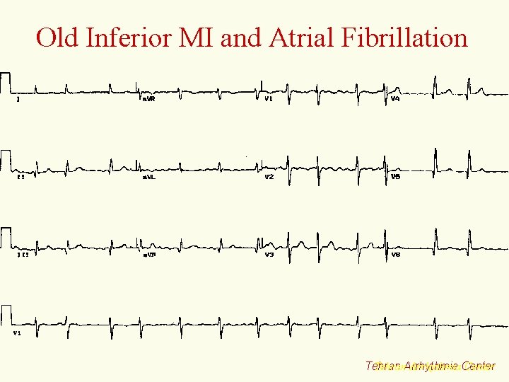 Old Inferior MI and Atrial Fibrillation Tehran. Arrhythmia. Center Tehran 