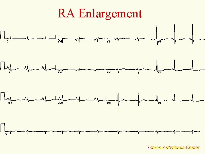 RA Enlargement Tehran. Arrhythmia. Center Tehran 