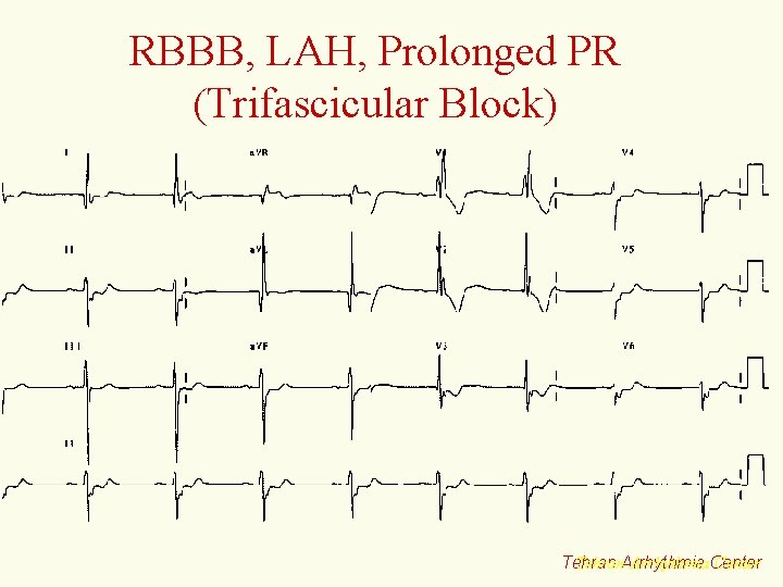 RBBB, LAH, Prolonged PR (Trifascicular Block) Tehran. Arrhythmia. Center Tehran 