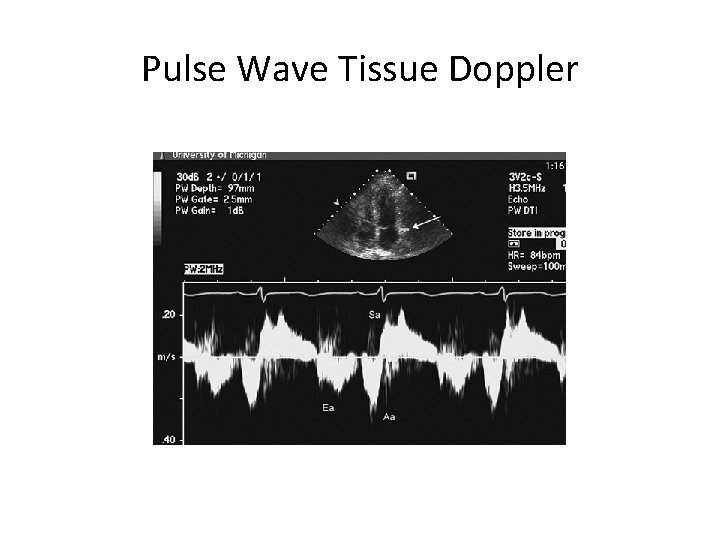 Pulse Wave Tissue Doppler 