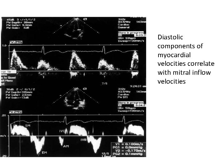 Diastolic components of myocardial velocities correlate with mitral inflow velocities 