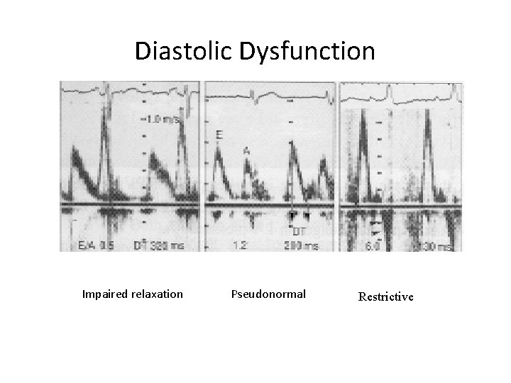 Diastolic Dysfunction Impaired relaxation Pseudonormal Restrictive 