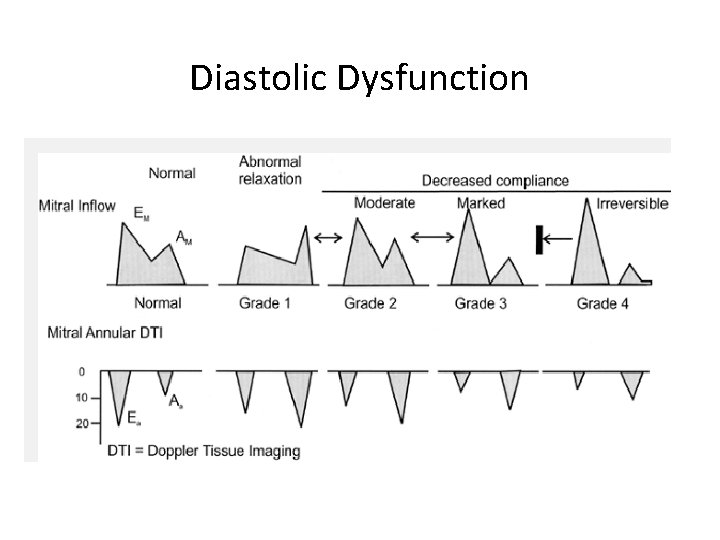 Diastolic Dysfunction 