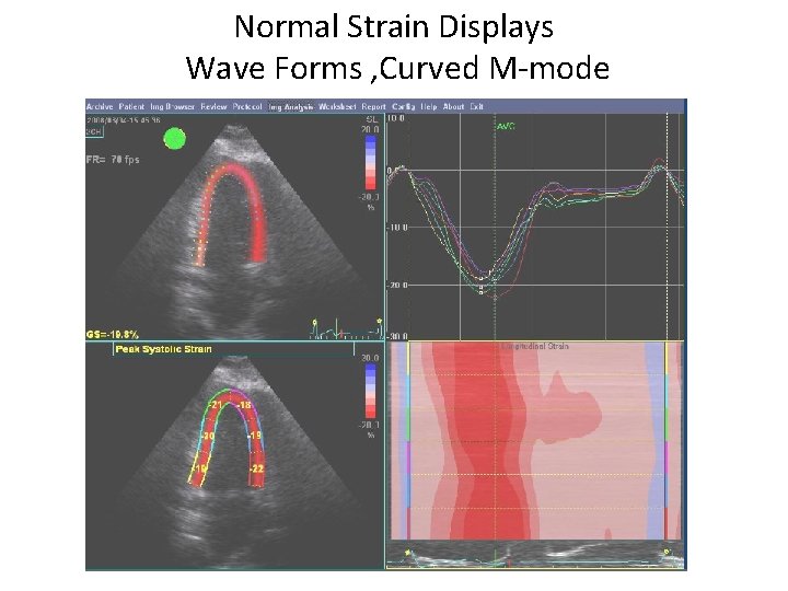Normal Strain Displays Wave Forms , Curved M-mode 