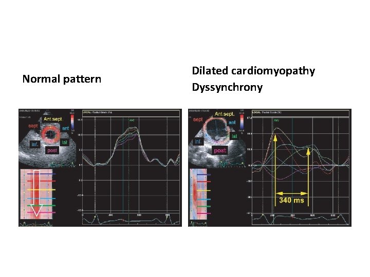 Normal pattern Dilated cardiomyopathy Dyssynchrony 
