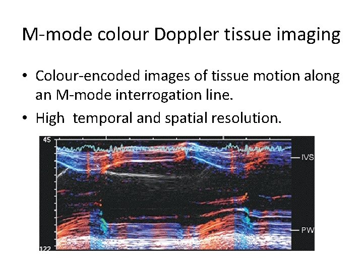 M-mode colour Doppler tissue imaging • Colour-encoded images of tissue motion along an M-mode