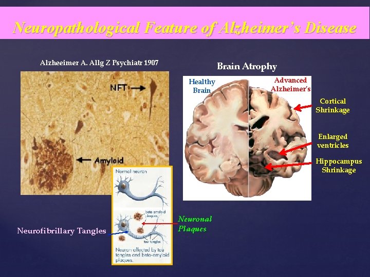 Neuropathological Feature of Alzheimer’s Disease Alzheeimer A. Allg Z Psychiatr 1907 Brain Atrophy Healthy