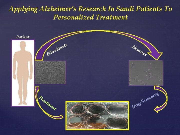 Applying Alzheimer’s Research In Saudi Patients To Personalized Treatment Patient ts s a bl