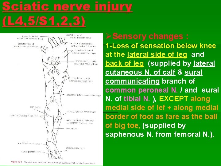 Sciatic nerve injury (L 4, 5/S 1, 2, 3) ØSensory changes : 1 -Loss Sciatic nerve injury (L 4, 5/S 1, 2, 3) ØSensory changes : 1 -Loss
