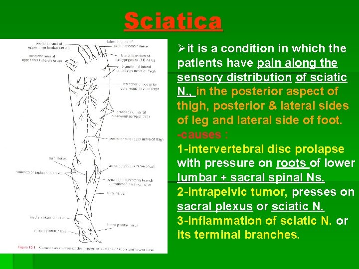 Sciatica Øit is a condition in which the patients have pain along the sensory Sciatica Øit is a condition in which the patients have pain along the sensory