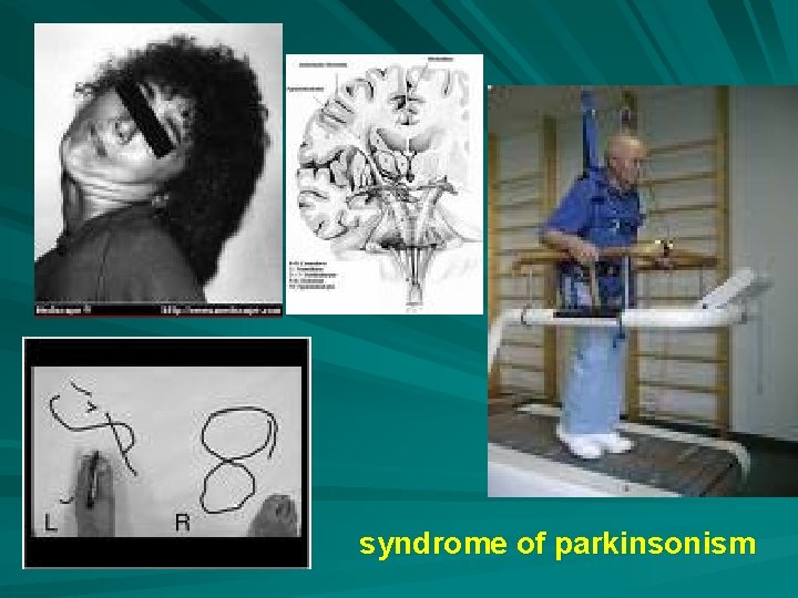 syndrome of parkinsonism 